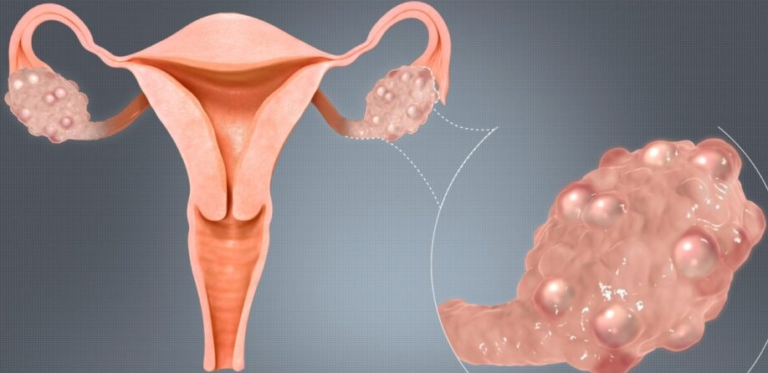 Homeopathic Treatment of PCOS:
